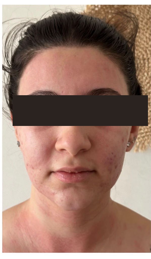 Before treatment