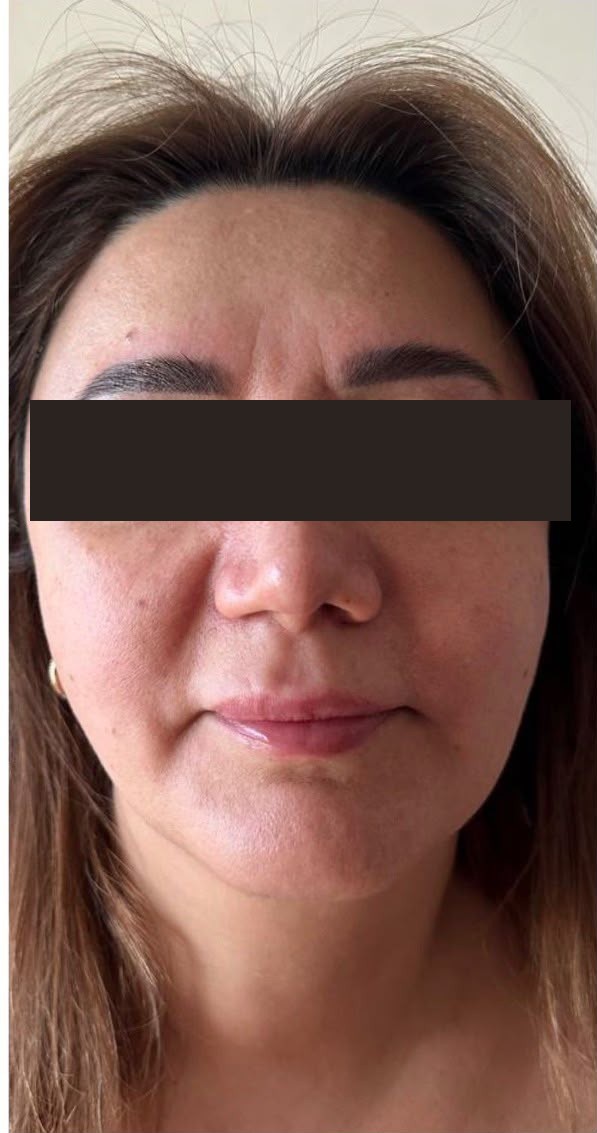 Before treatment